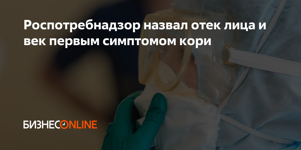 Роспотребнадзор назвал отек лица и век первым симптомом кори