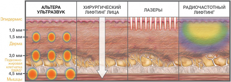 Ультразвуковое воздействие на кожу и мышечно-апоневротический слой позволяет отсрочить хирургическую подтяжку лица на долгие годы, а можно сказать и десятилетия