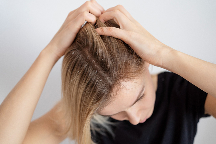 Сбой в работе иммунных клеток может стать причиной не только нарушения роста волос, но и раннего облысения