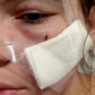 «Со мной остается изуродованное лицо»: на косметолога из Кирова напали в казанском клубе